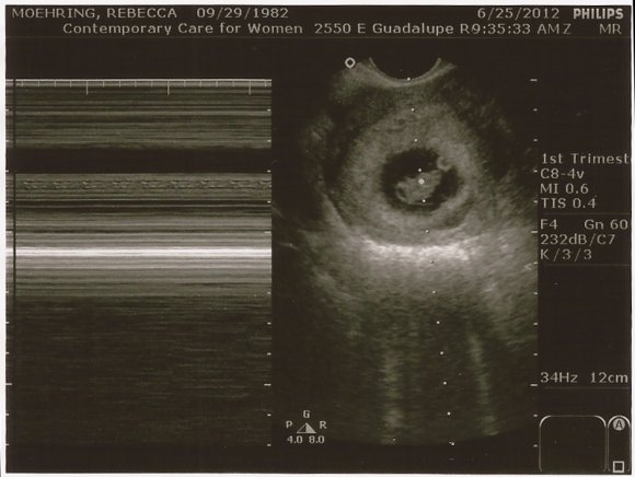 02 ultrasound heartbeat