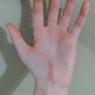 volleyball bruises (1)