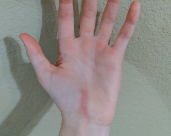 volleyball bruises (1)