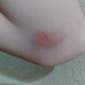 volleyball bruises (2)