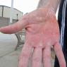 blister