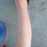 rash