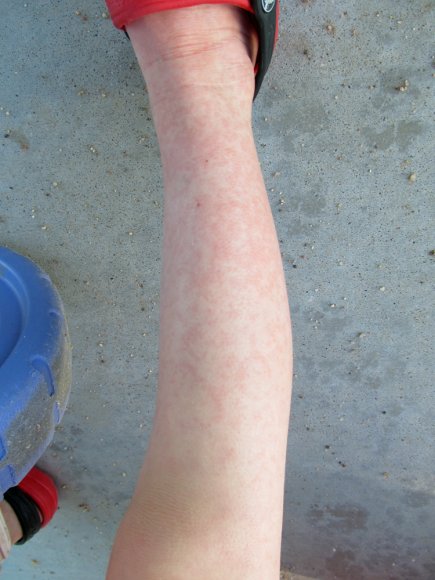rash