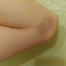 volleyball bruises (3) a few days later
