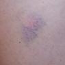 02 bruise