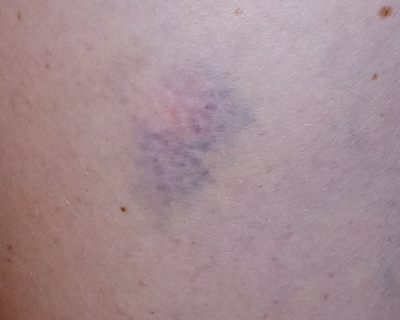 02 bruise